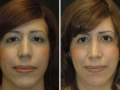 Rhinoplasty