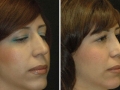 Rhinoplasty