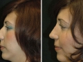 Rhinoplasty