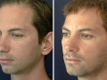 Rhinoplasty