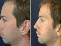 Rhinoplasty