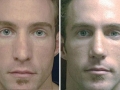 Rhinoplasty