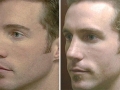 Rhinoplasty