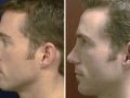Rhinoplasty