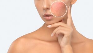 Laser Skin Resurfacing in Los Angeles